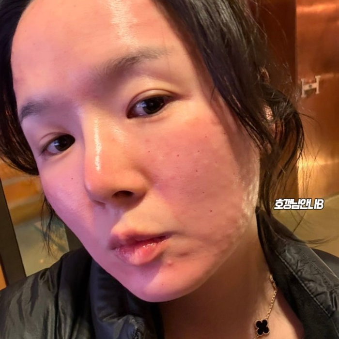 네이버 인플루언서 [네이버 인플루언서] 스킨부스터 리주란+ 포텐자 해봄